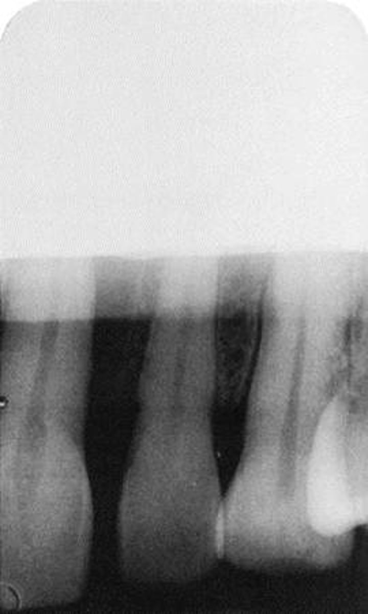 <p>-Digital or phosphor plate = Computer processing error.</p><p>-Laser scanner is off balance or bad connection</p><p>-A straight blank white border due to underdeveloped portion. The film may not be completely immersed in the developer solution</p>