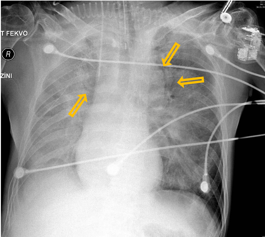<p>Patient history: postoperative condition, cardiac failure </p><p>Modality: AP chest radiograph </p><p>Region: chest, lungs </p><p>Radiologic sign: Extensive, bilateral perihilar opacities with air bronchograms (yellow arrow). Right diaphragm cannot be differentiated, on this side homogeneous loss of transparency can be seen due to the extending pleural effusion. </p><p>Diagnosis: severe pulmonary edema, right-sided hydrothorax</p>