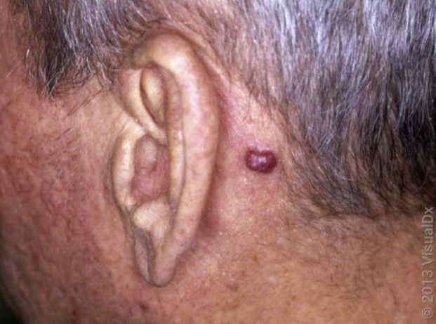 <p>cherry angioma characteristics </p>