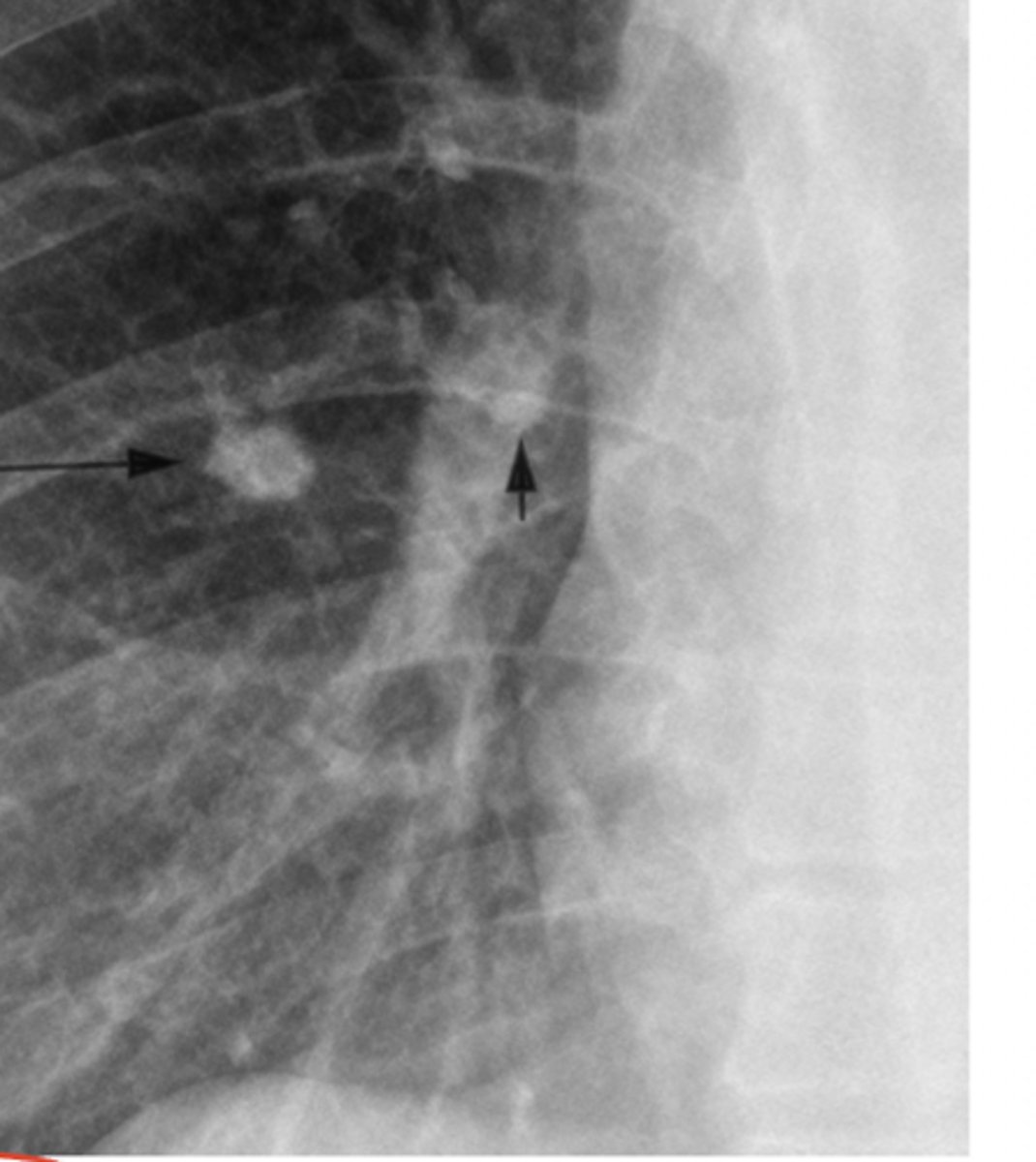 <p>Name this calcification that is associated with Tuberculosis</p>