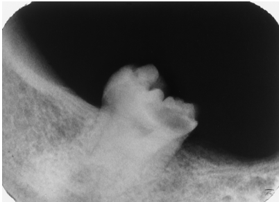 <p><span><span>This tooth has a carious lesion, is broken down, and the dentist is contemplating extraction. Which one factor seen here is MOST likely to complicate the extraction?</span></span></p><p>&nbsp;</p><p>ankylosis</p><p>&nbsp;</p><p>large carious lesion</p><p>&nbsp;</p><p>short crown length</p><p>&nbsp;</p><p>apical osteosclerosis</p>