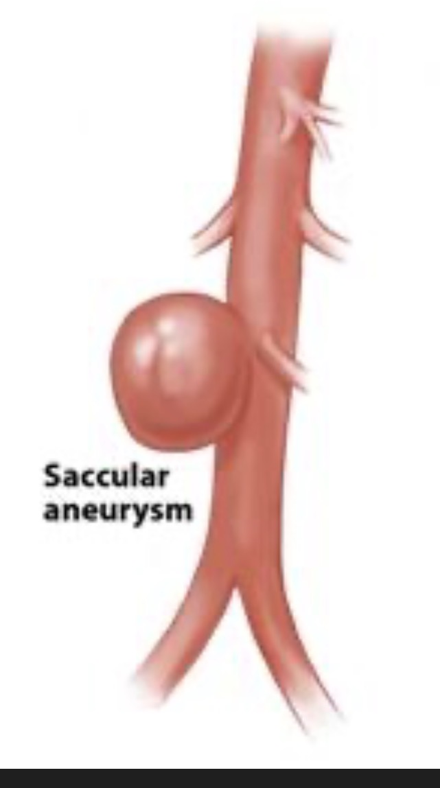<p>Whats a saccular aneurysm? </p>