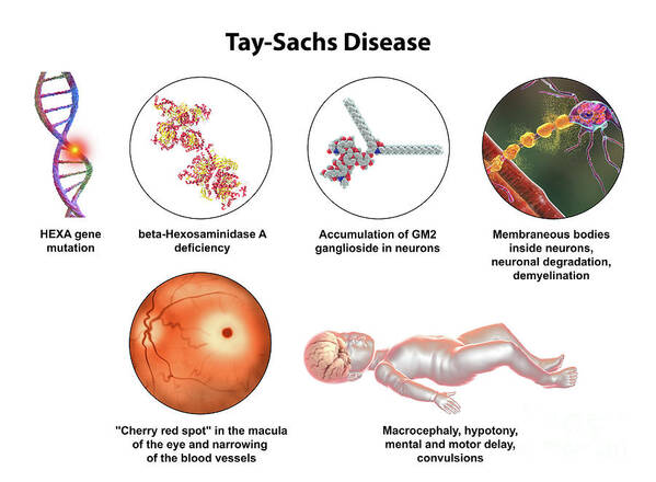 <p>Tay-Sachs</p>