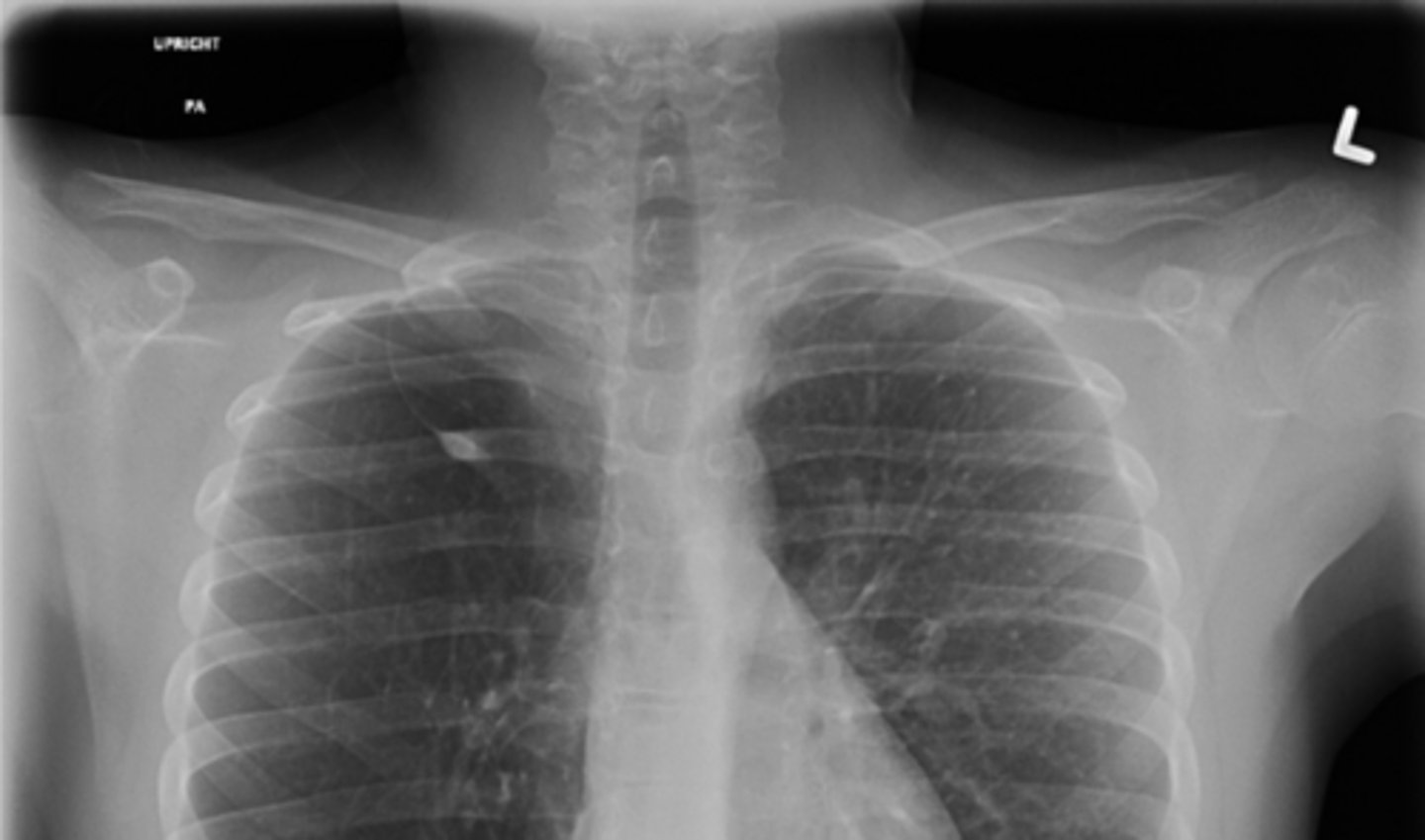 <p>What normal variant is present here?</p>