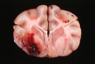 <p>what type of hemorrhage is this?</p>
