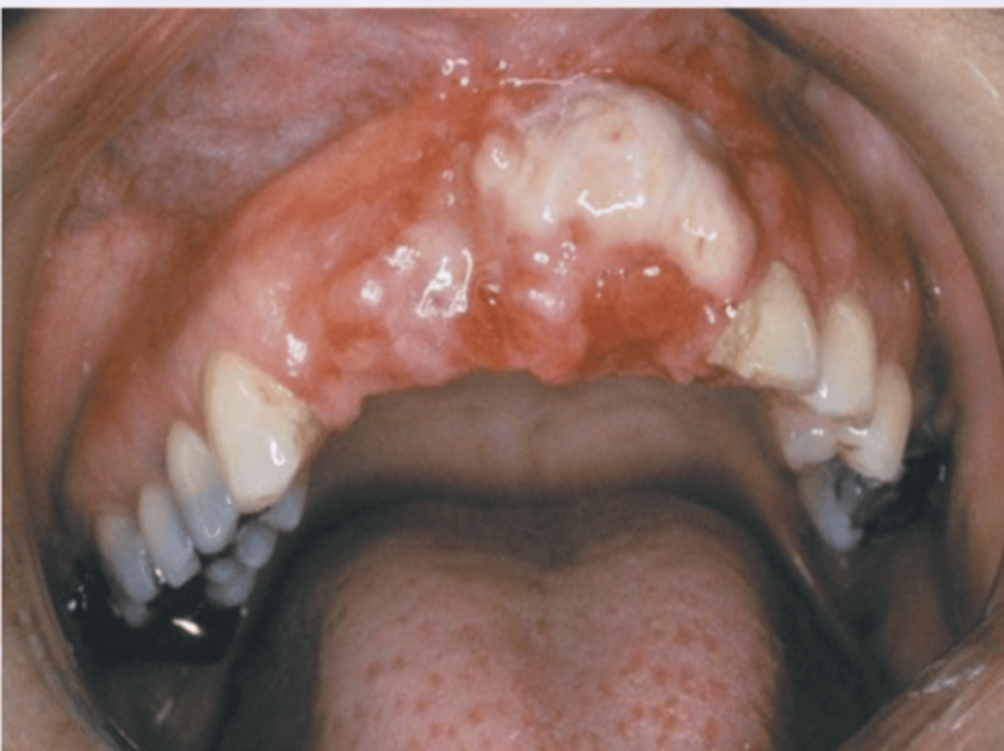 <p>Derived from vascular smooth muscle</p><p>7% of all soft tissue sarcomas</p><p>RARE in oral cavity</p>
