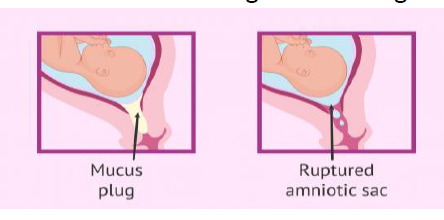 <p>Uterus small for gestational age<br>leaking AF<br>Decreased amount of AF</p>