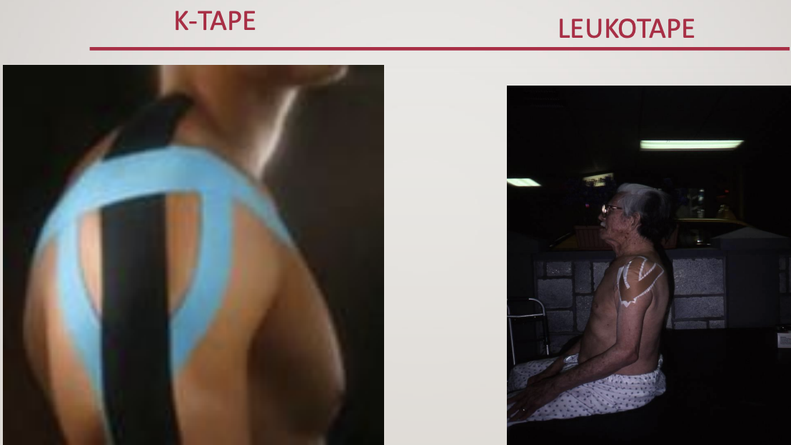 <p><strong><em><u>KinesioTape-</u></em></strong> <strong><u>more flexible</u></strong> (left photo), <strong><u>providing more facilitation to strengthen muscles&nbsp;</u></strong></p><ol><li><p><strong><u>Facilitates</u></strong> (<strong><u>weak</u></strong>) <strong><u>muscles</u></strong> or <strong><u>inhibits</u></strong> (<strong><u>tight</u></strong>) <strong><u>muscles</u></strong></p></li><li><p><strong><u>Removes swelling</u></strong></p></li><li><p><strong><u>Activates Analgesic System</u></strong></p></li><li><p><strong><u>Commonly used with little evidence</u></strong></p></li></ol><p><strong><em><u>Athletic Tape/Strapping</u></em></strong><em>-</em> <strong><u>more rigid</u></strong> (right photo), <strong><u>providing more structural support to put muscles back in place&nbsp;</u></strong></p><p>1. <strong><u>Stabilizes</u></strong></p><ol start="2"><li><p><strong><u>Re-aligns</u></strong></p></li><li><p>Some evidence to <strong><u>decrease pain</u></strong></p></li></ol><p></p>