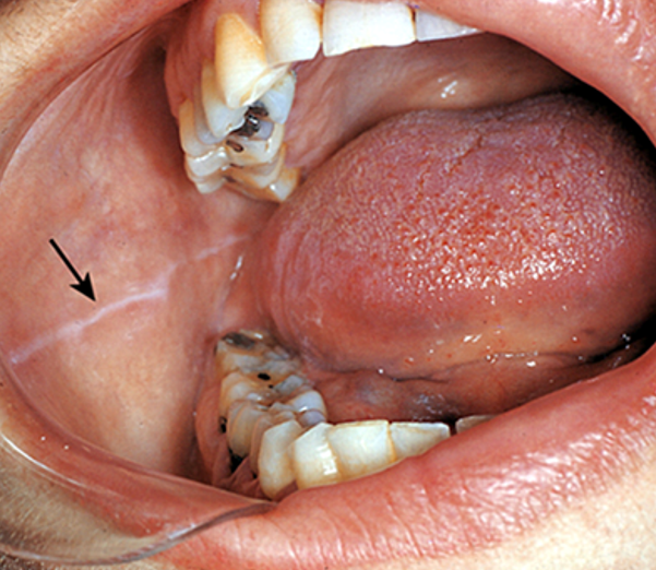 <ul><li><p>Chronic irritation of teeth against buccal mucosa causes keratinization of lining mucosa</p></li><li><p>Results in white line</p></li></ul><p></p>