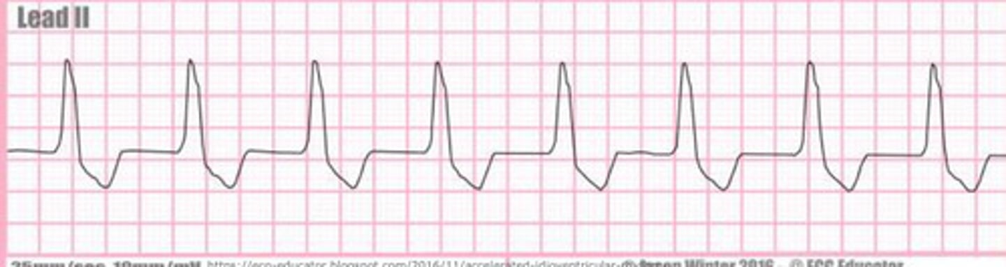 <p>What arrhythmia is this?</p>