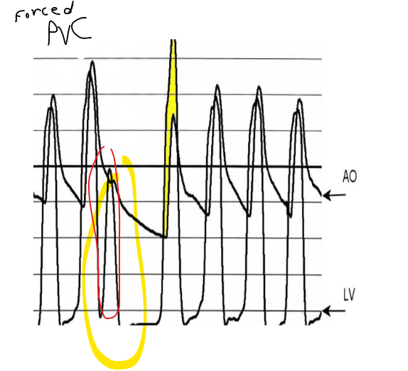<p>post PVC ao systolic gradient you could only have a ****</p>