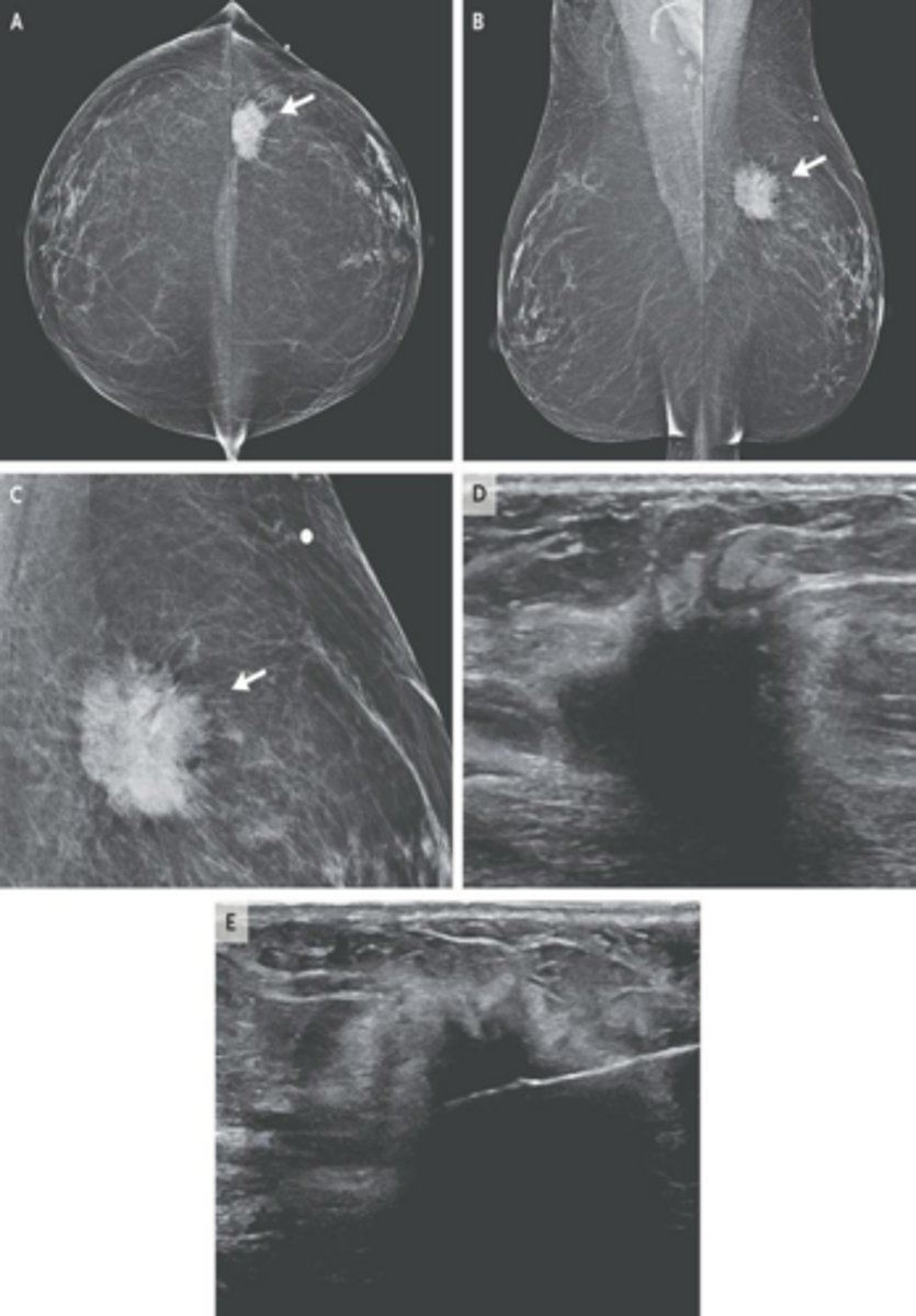 <p>Diagnostic mammogram and ultrasound.</p>