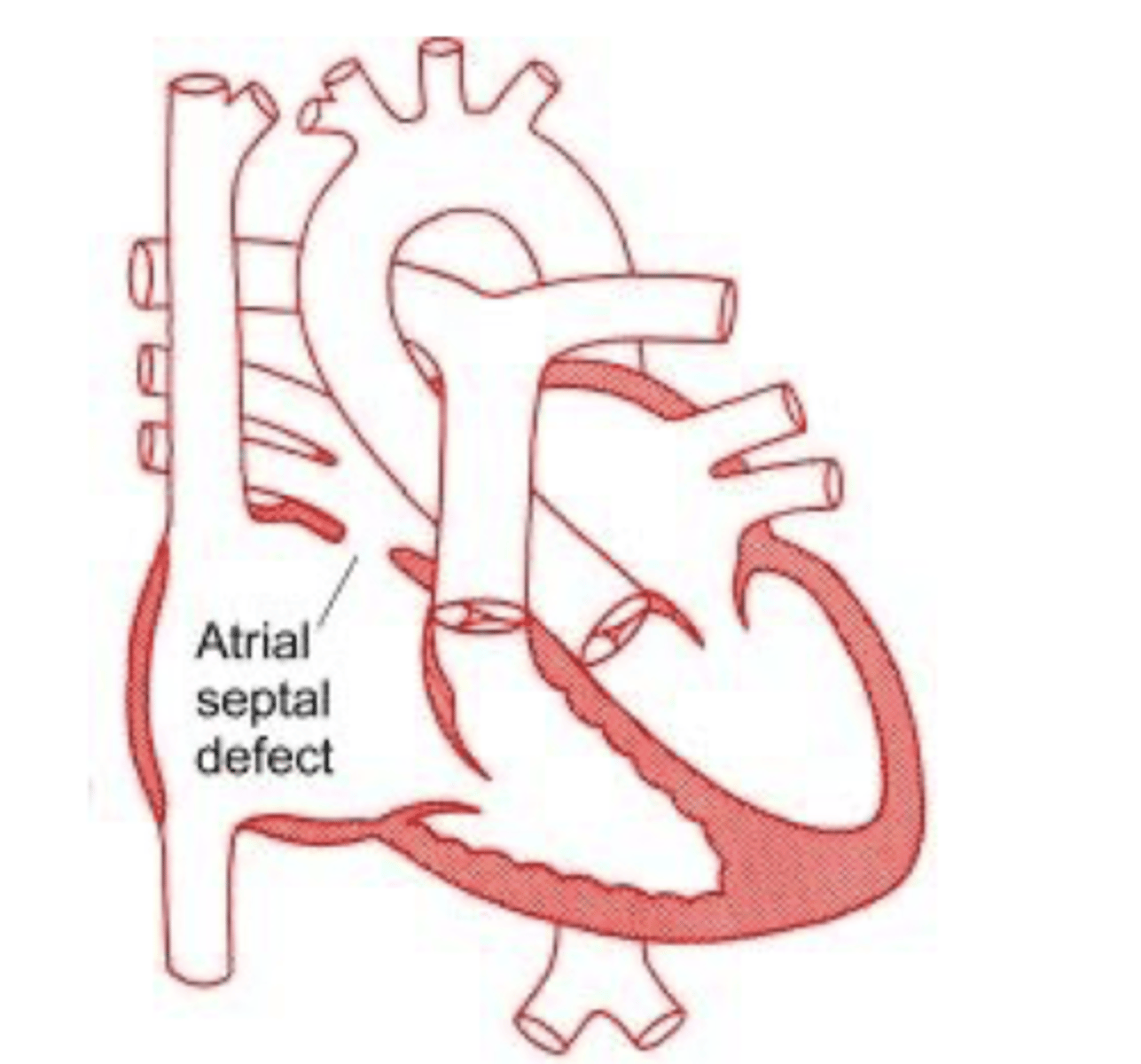 <p>Atrial septal defect</p><p>-blood is going through an additional opening out of the atrium</p>