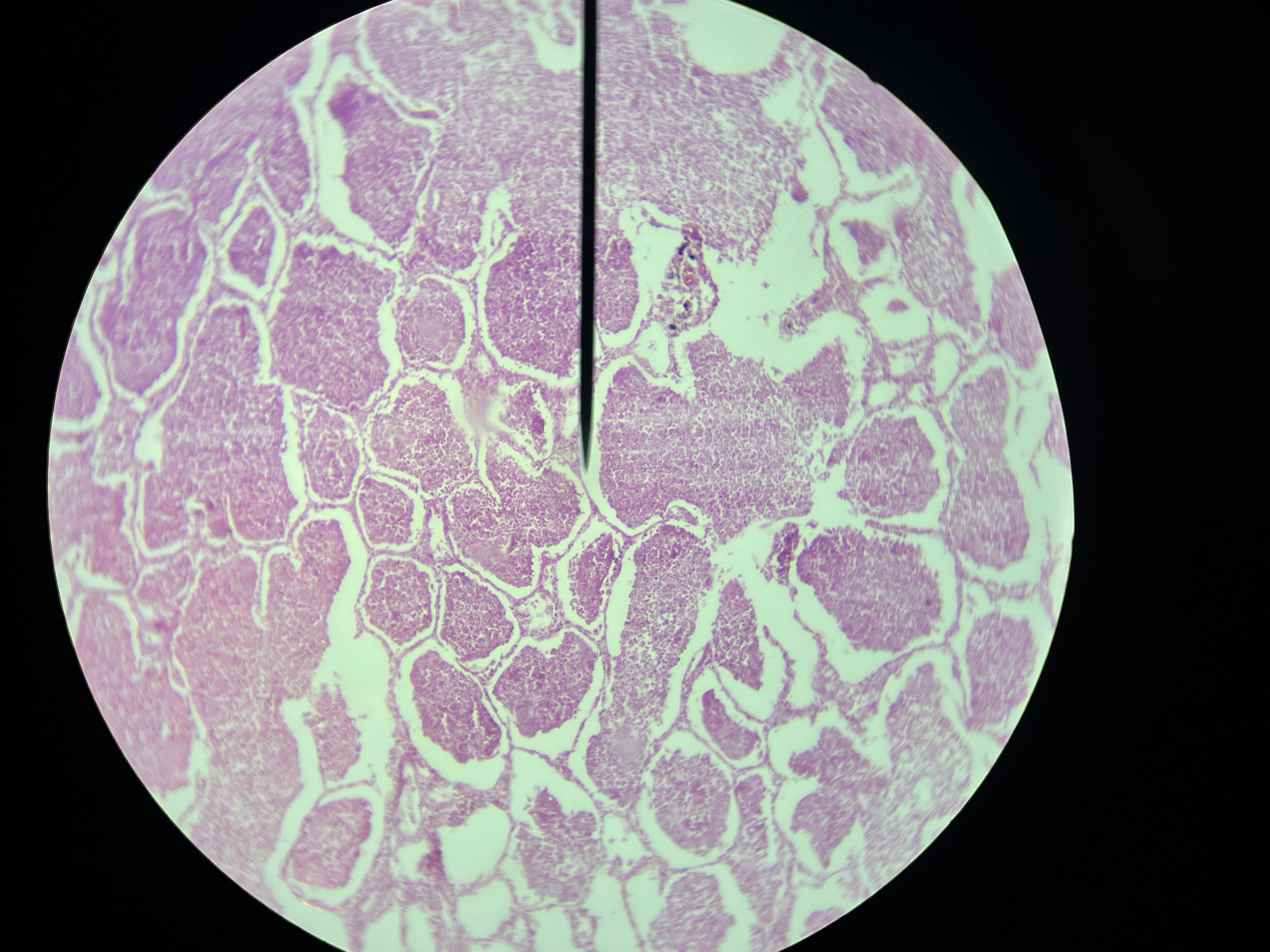 <p>an infection that affects a large and continuous area of the lobe of a lung, often characterized by consolidation of lung tissue and symptoms such as cough, fever, and difficulty breathing. </p>