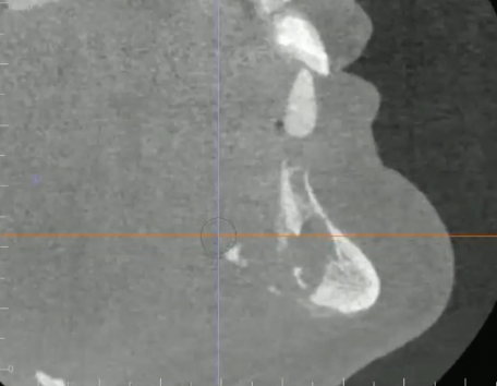 <p>osteolytic, small sequestrum, and periosteal bone formation, likely diagnosis?</p>