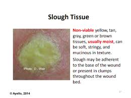 Yellow tissue needing removal for proper healing of a wound.