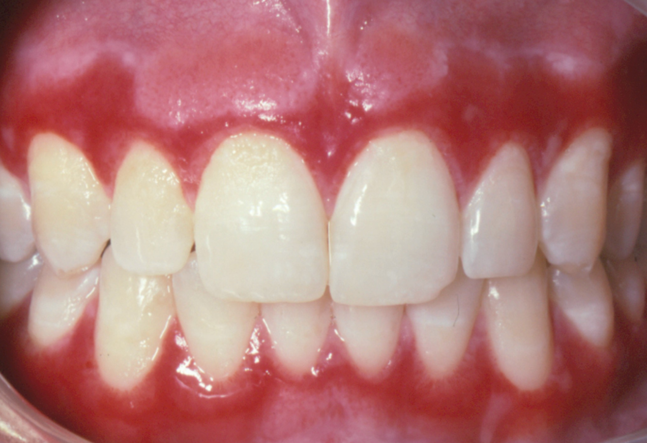 <p>3d. Which feature is characteristic of mucous membrane pemphigoid?</p>