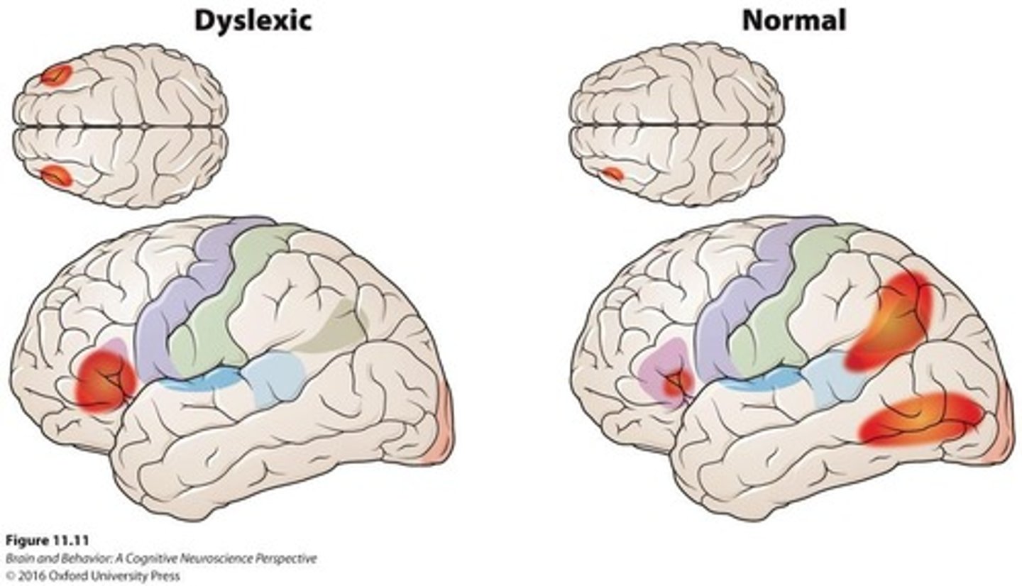 <p>A learning difficulty in reading, associated with less activity in Wernicke's area and compensatory activity in other language areas.</p>