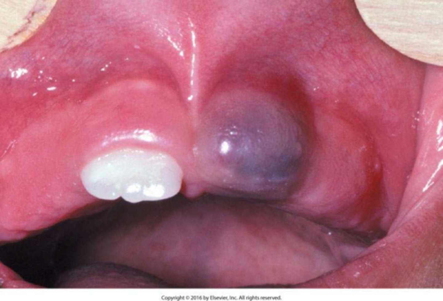 <p>bluish swelling at site of erupting tooth (1st molar)</p><p>• population: children</p>