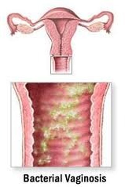 <p>inflammation of vagina</p>