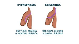 <p><strong>Epispadias</strong></p><p>-Rare birth defect in which the _________ does not fully _________ and the urethral _________ is on the ___ of the penis</p><p>-Urethra may not develop into a full ____</p>