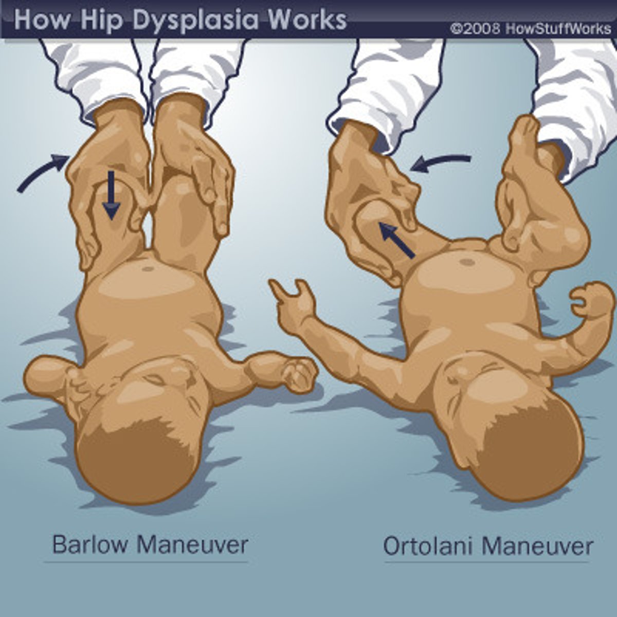 <p>A manual procedure performed to rule out the possibility of developmental dysplastic hip.</p>