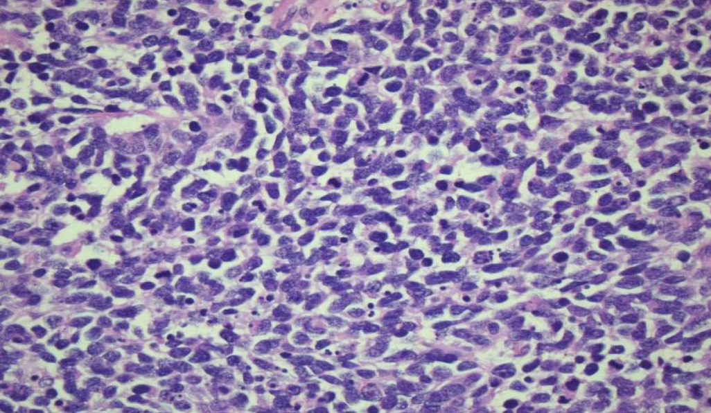 <p>high grade tumor with scant cytoplasm, ill-defined borders, finely granular nuclear chromatin (“salt and pepper”), absent or inconspicuous nucleoli; extensive necrosis and <u>excessive mitotic activity</u></p>
