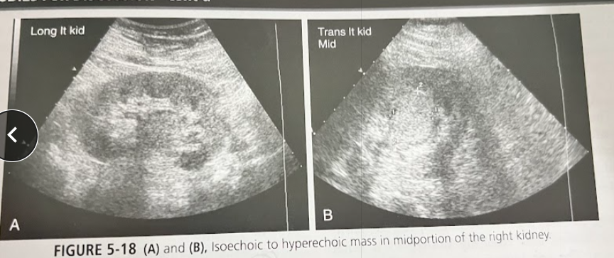 <p>A 45 year old, mildly obese woman sees her doctor w/ complaints of RUQ pain, N/V after eating. Lab analysis reveals elevated cholesterol levels and microscopic hematuria. The exam is positive for gallstones. During the course of the exam, the sonographer discovers an incidental solid, well-defined iso/hyperechoic mass. There is a central scar w/in mass (shown on CT). What is the most likely diagnosis?</p>