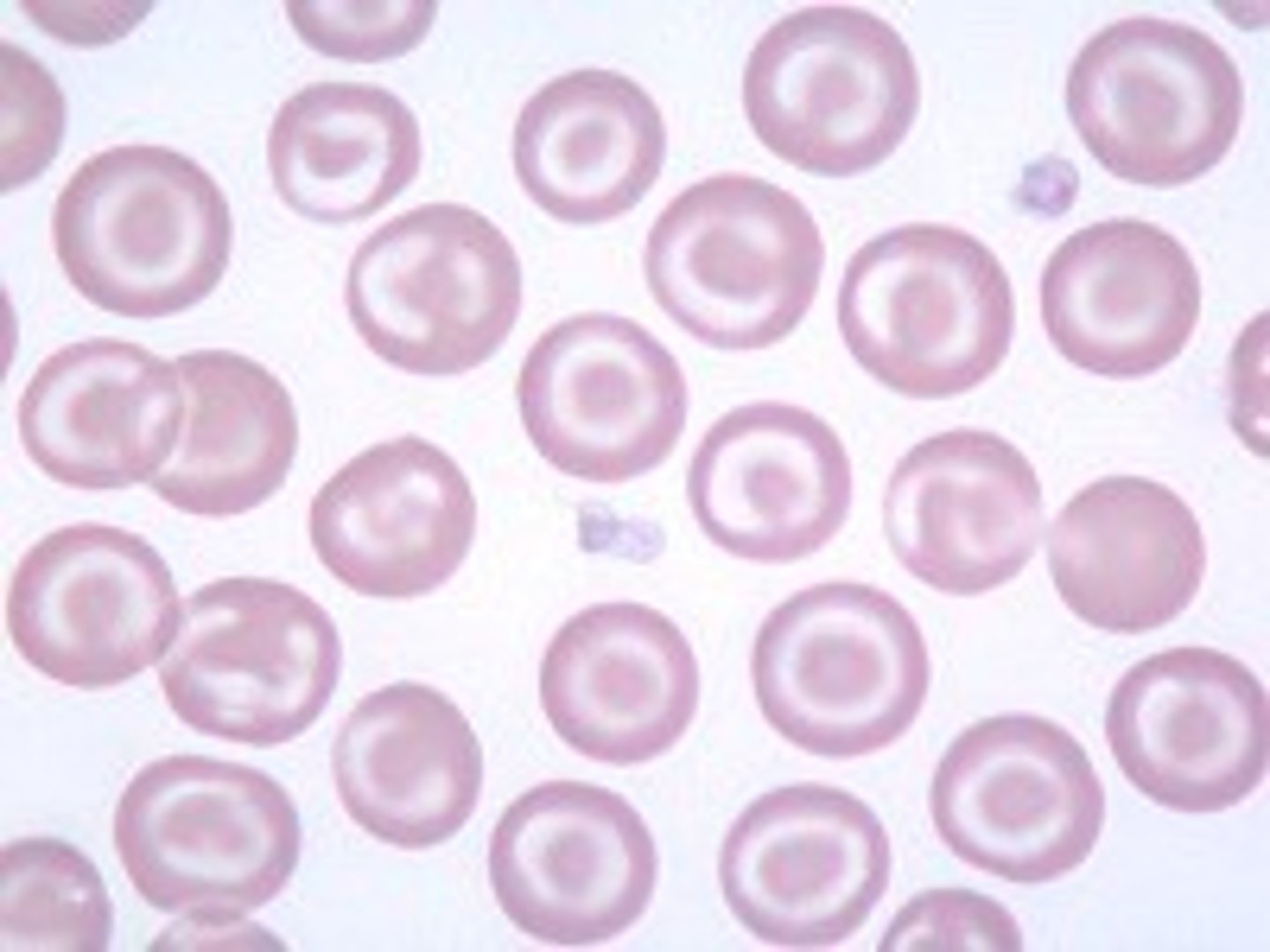 <p>in hypo/micro = beta thalassemia (hgbinopathies), IDA</p><p>in macro = liver disease</p><p>sideroblastic anemia</p>