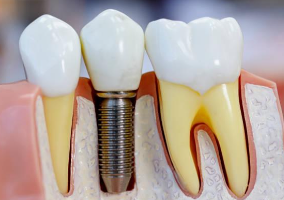 <p>Define dental implant</p>