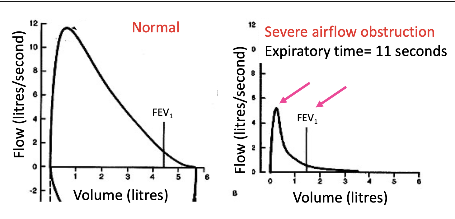 Forced vital capacity