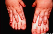 <p>blisters develop at site of pressure, rubbing or trauma</p>