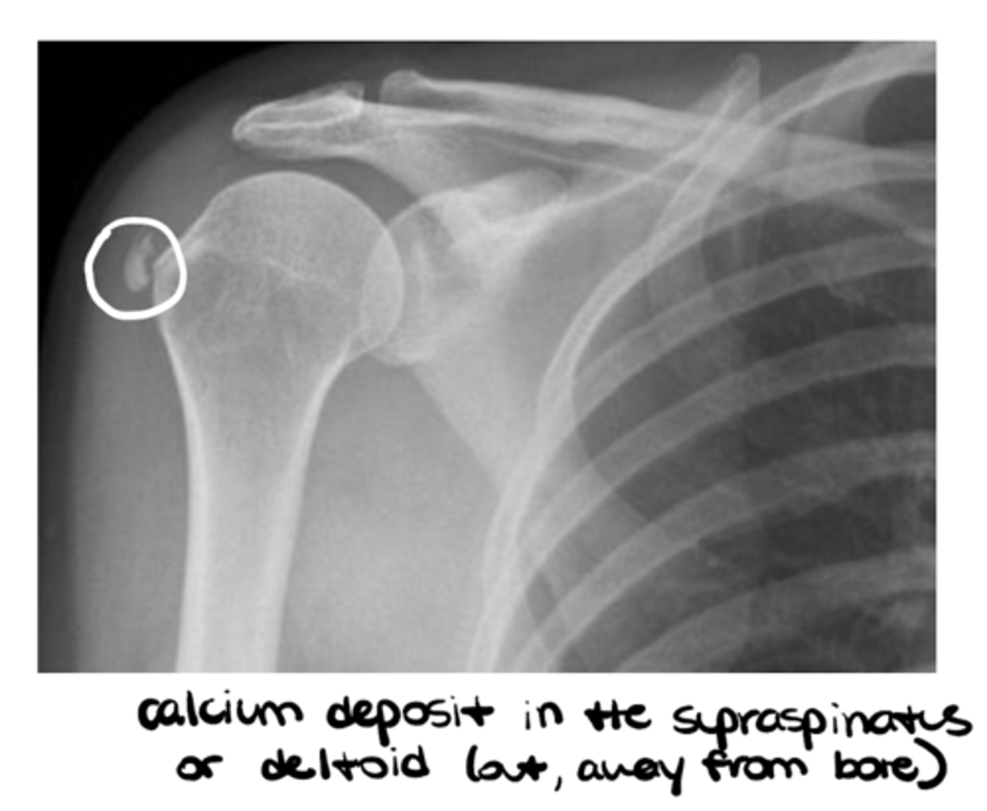 <p>- Foreign body</p><p>- Calcifications</p>