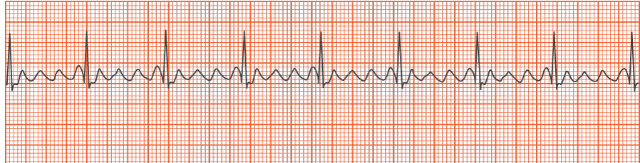 Which of the following rhythms is shown in the strip above?


1. Atrial fibrillation
2. Premature atrial complex
3. Atrial flutter
4. Atrial tachycardia