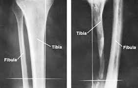 <p>an inflammation of the bone and marrow caused by a variety of infectious organisms. infectious organisms reach bone by hematogenous spread, extensioun from an adjacent site of infection, ordirect introduction of organisms (after trauma or surgery).</p>