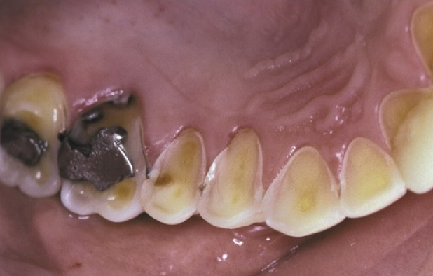 <ul><li><p>Palatal surfaces affected</p></li><li><p>Exposed dentin with a concave surface showing peripheral white line of enamel</p></li></ul><p></p>