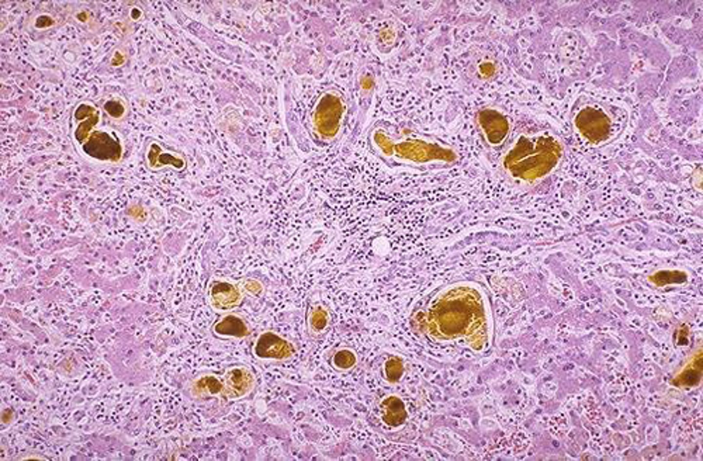 <p>Accumulation of bile pigment in Kupffer cells is consistent with:</p>