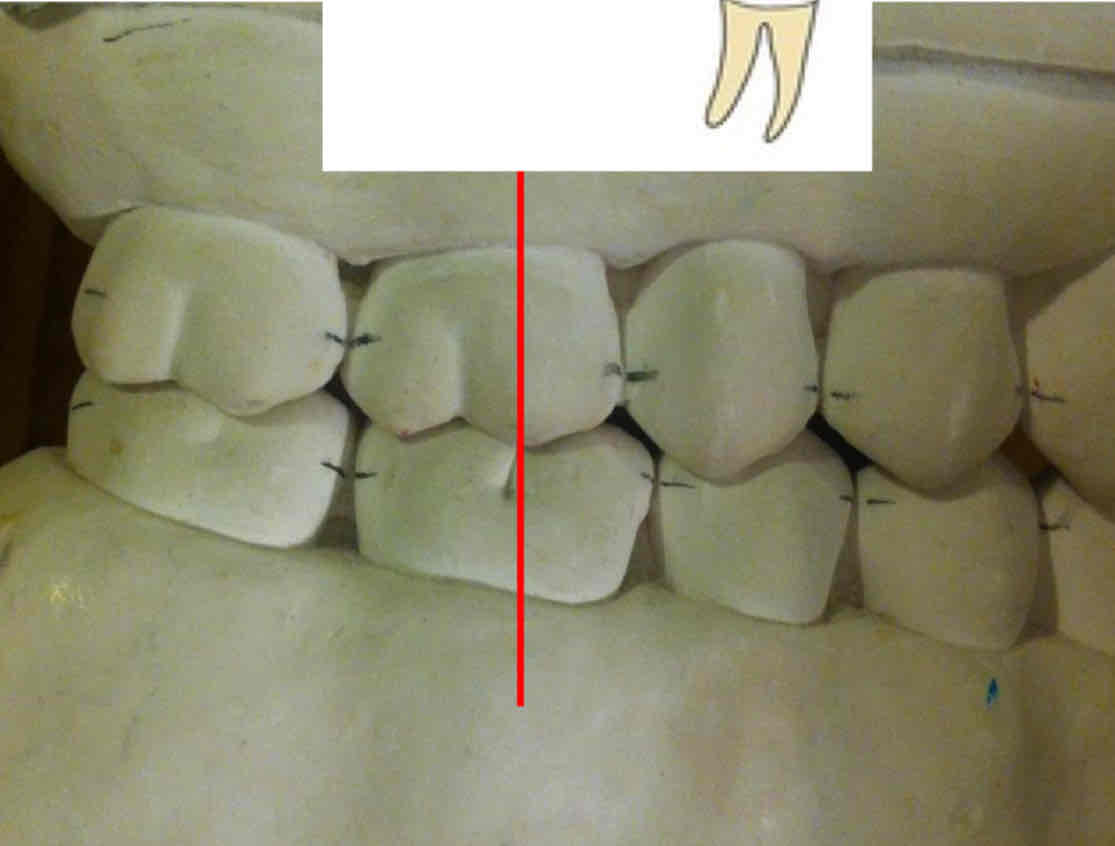 <p>what is class I molar occlusion (most common type)</p>