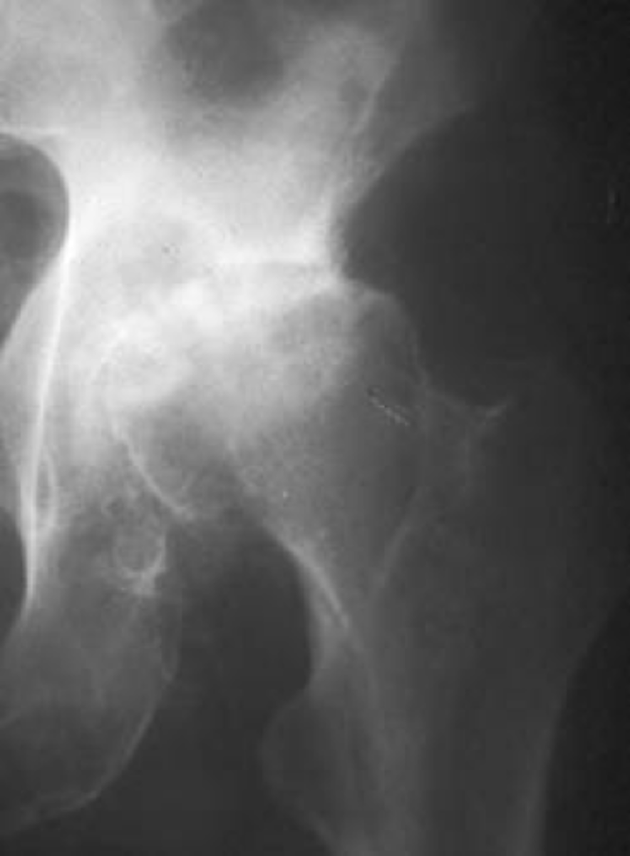 <p>With osteoarthrosis of the hip joint, the _____ joint space is most commonly involved</p><p>- Superior migration of femoral head</p>