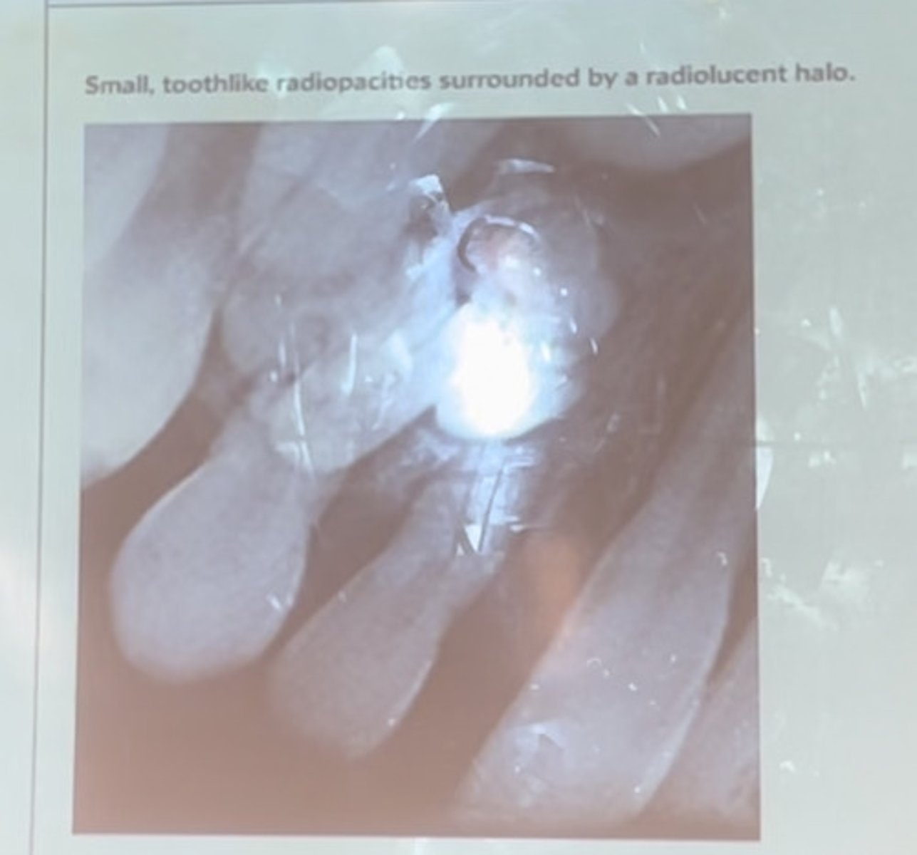 <p>Small, toothlike radiopacities surrounded by a radiolucent halo</p>