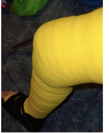 <p> Slow progressive low load stretch over an extended period of </p><p>time</p><p> Changed weekly increasing stretch each cast  Indicated in patient with higher risk for permanent contracture </p><p>who currently lack ROM</p><p> Indicated for patients with potential for consistent standing </p><p>program, ambulation, functional transfers, improvement with </p><p>positioning in wheelchair</p>