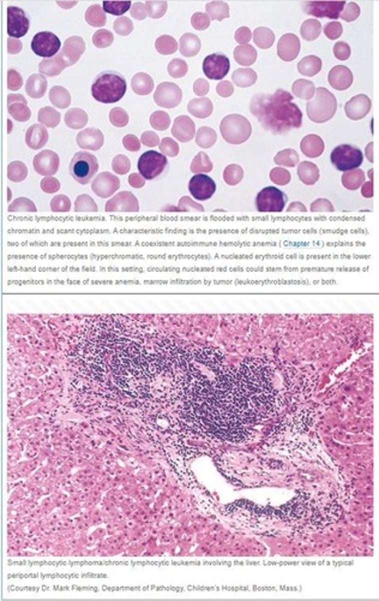 <p>They are required for the diagnosis of Hodgkin lymphoma. They induce accumulation of reactive lymphocytes</p>