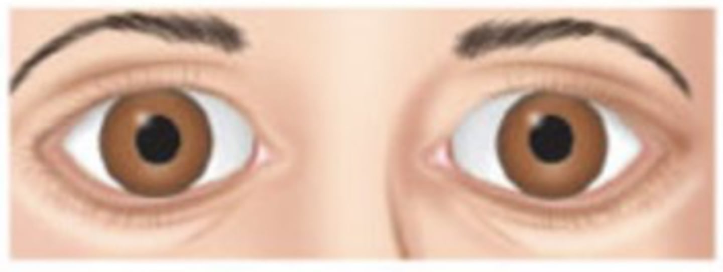 <p>Structural damage in the midbrain</p>