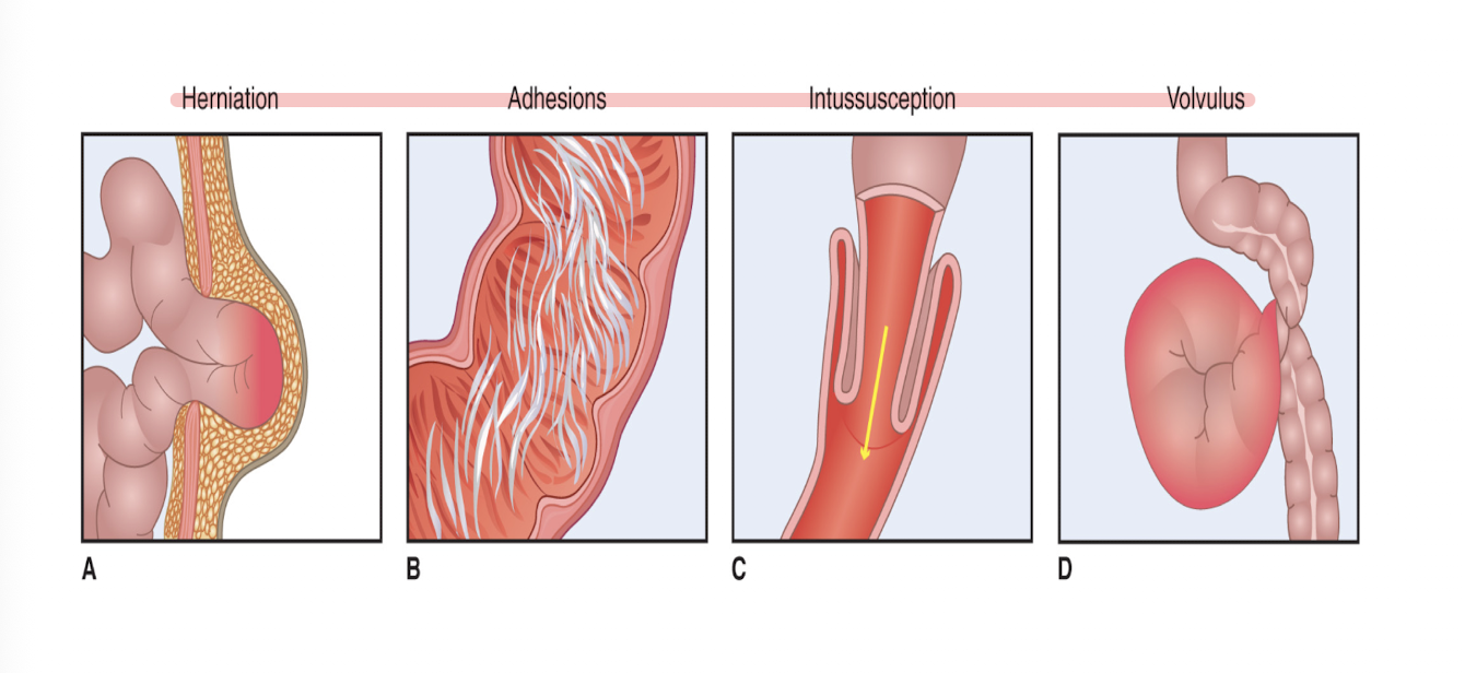 <ul><li><p>Manifestations </p><ul><li><p>Abdominal pain, nausea, vomiting, abdominal distention, and inability to satisfactorily pass gas or stool</p></li><li><p>Hyperactive, high-pitched bowel sounds often present </p></li><li><p>Bowel sounds will be absent if ileus develops</p></li></ul></li><li><p>Treatment </p><ul><li><p>Medical management includes gastric decompression, intravenous fluids, and serial physical and serum tests</p></li><li><p>Surgery may be indicated if medical management fails</p></li><li><p>If strangulation and bowel ischemia present- emergent surgery needed</p></li></ul></li></ul><p></p>