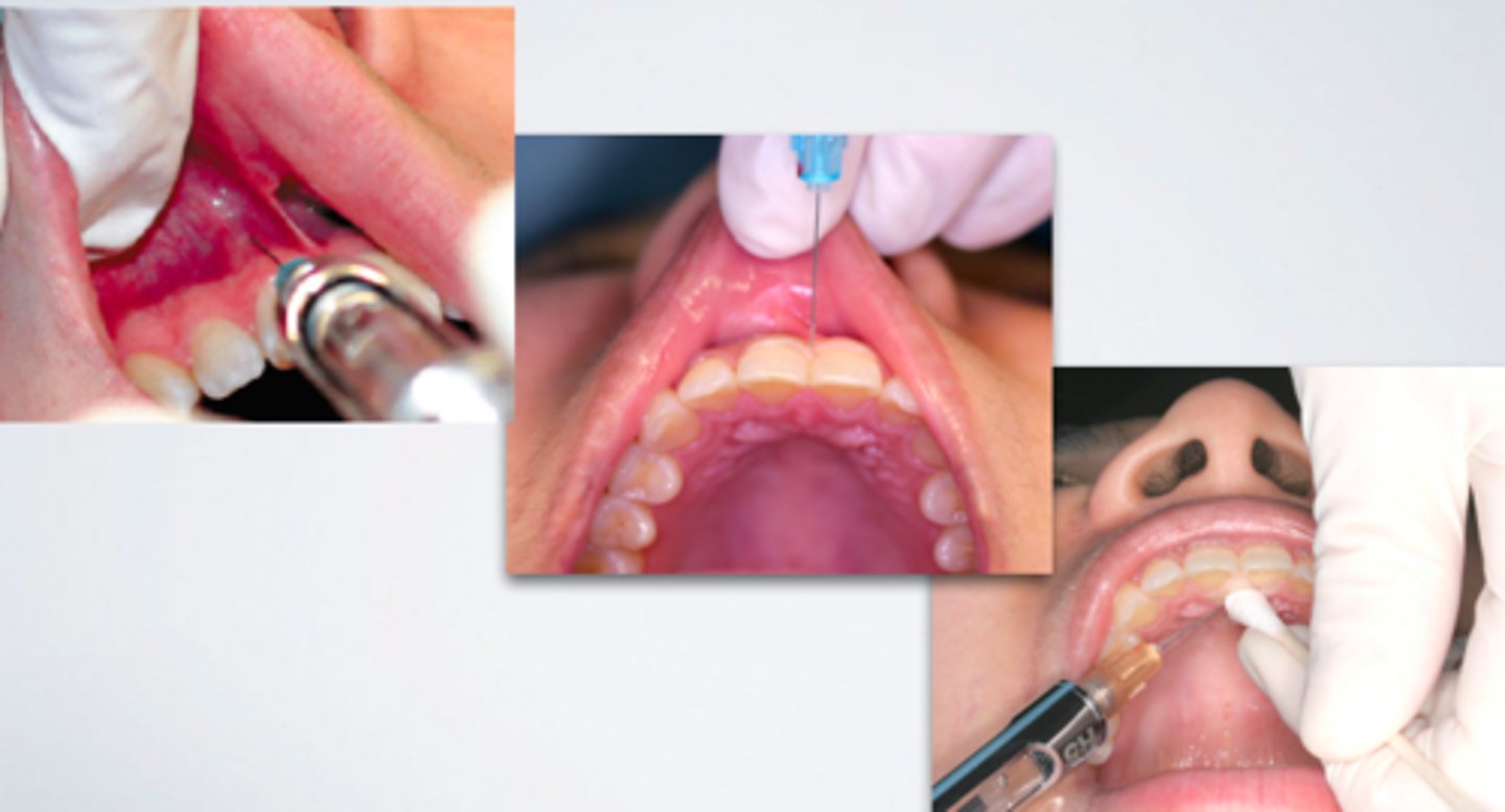 <p>ID the anesthesia technique:</p>