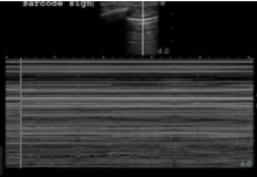 <p>What does the Barcode sign indicate?</p><p><strong>*seen in M-mode</strong></p>