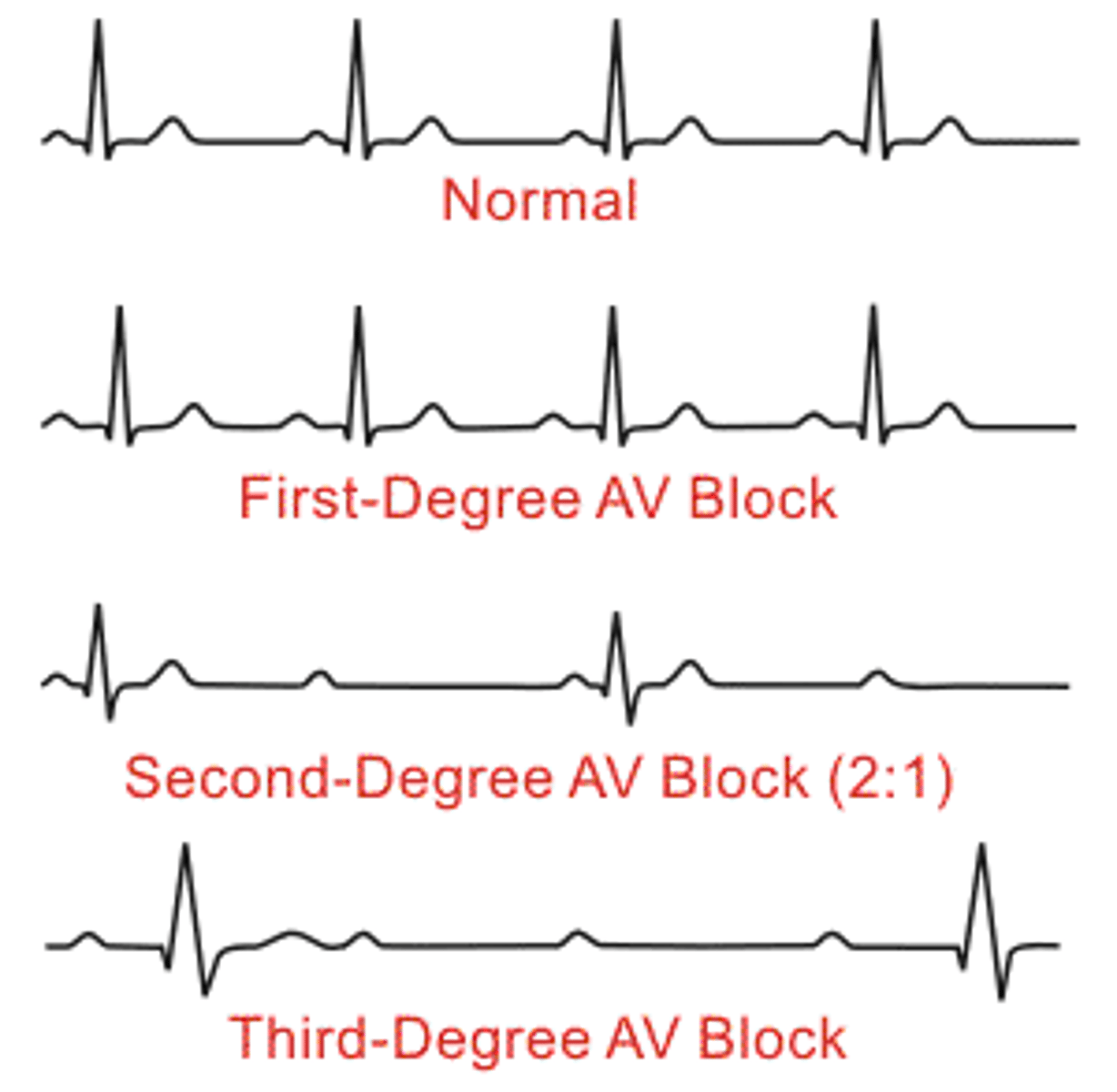 <p>Regular</p><p>Rate: 60-100</p><p>P Wave: Present, upright</p><p>PR interval: &gt;0.20 sec CONSISTENTLY LONG</p><p>QRS: &lt;0.12 sec</p><p>Husband stays late till 9 consistently</p>