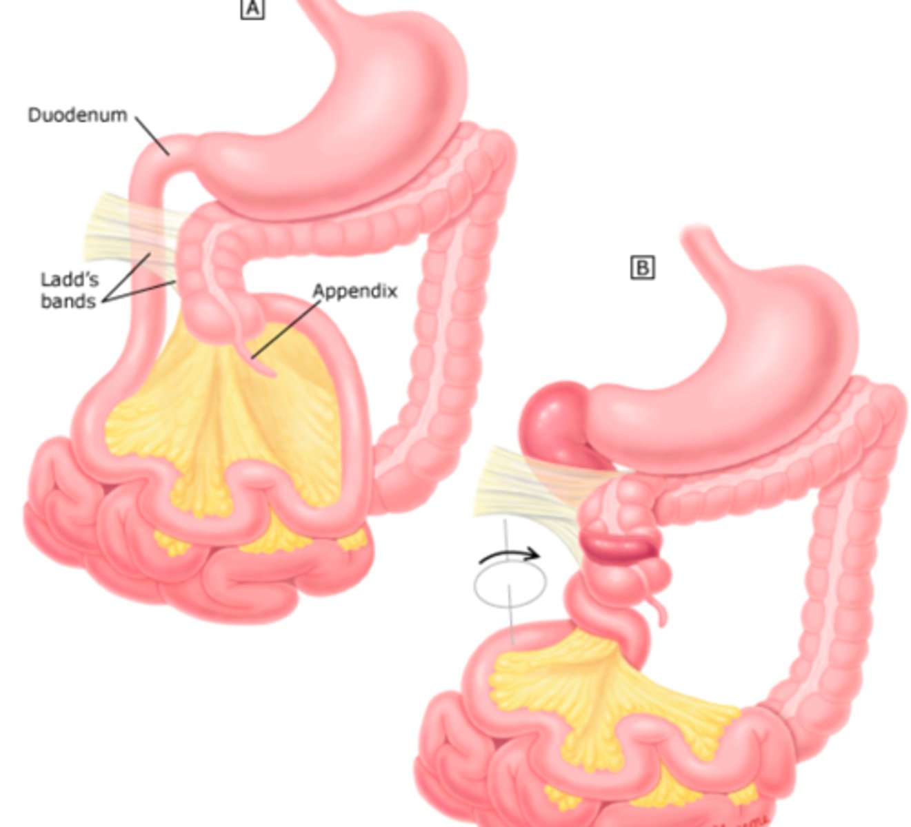 <p>Abnormal/incomplete rotation of the bowel during fetal development; Ladd's bands (fibrotic bands that cover parts of the small intestine)</p>