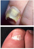 <p><strong>Clinical Manifestations of Onychomycosis Due to Dermatophytes</strong></p><p>-Distal _______, most common </p><p>-Superficial white, hallux preferentially affected with white _____ on nail plate </p><p>-Proximal, begins are _______ part of nail plate </p>