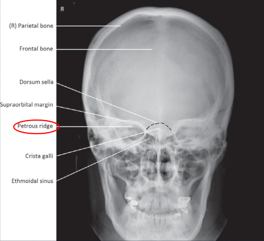 <ul><li><p>evidence of proper collimation</p></li><li><p>entire cranial perimeter showing three tables of squamous bone</p></li><li><p>no rotation:</p><ul><li><p>equal distance from lateral borders of skull to lateral border of orbits</p></li><li><p>symmetric petrous ridges</p></li></ul></li><li><p>petrous ridges fill orbits</p></li><li><p>penetration of frontal bone without excessive density of lateral borders of skull</p></li></ul><p></p>